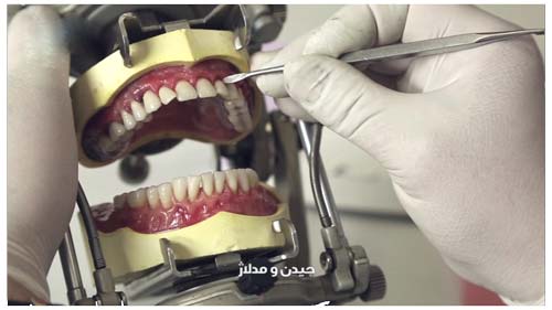 چیدن مدلاژ در ساخت پروتز دندان به روش کستینگ