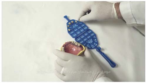 موم زدایی از دندان متحرک ساخته شده به روش کستینگ
