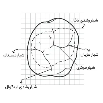 آناتومی-دندان-مولار-اول-5