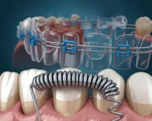 فینگر اسپرینگ چیه و چطور ساخته میشه؟