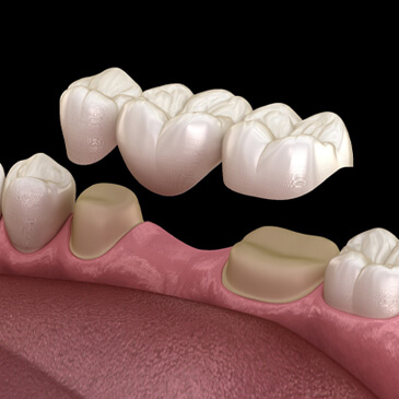 دندان مصنوعی بریج