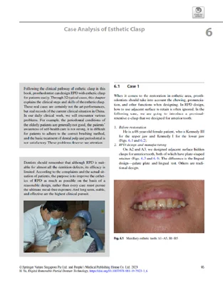 digital-removable-partial-denture بخش ششم