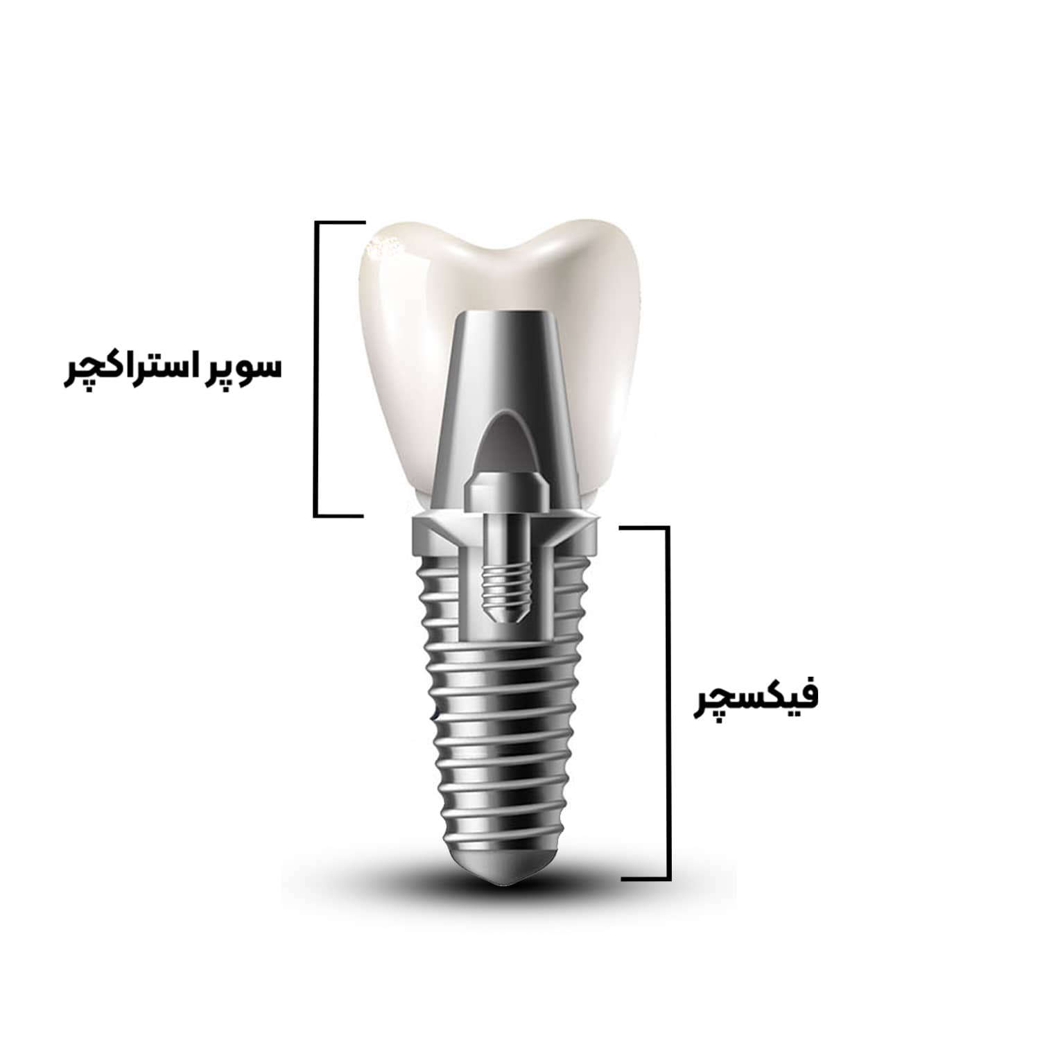 تقسیم-بندی-کلی-آناتومی-ایمپلنت-دندان