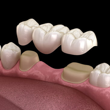 دندان-مصنوعی-بریج